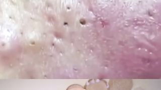 Derm reacts to Super Satisfying pimple pops! #dermreacts #doctorreacts #pimplepopper