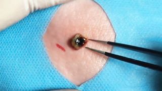 BEST Pimple Popping Big Cystic Acne Blackheads Whiteheads Removal Squeezing Pimples H046_720p - 001