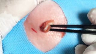 BEST Pimple Popping Big Cystic Acne Blackheads Whiteheads Removal Squeezing Pimples H046_720p - 002