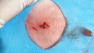BEST Pimple Popping Big Cystic Acne Blackheads Whiteheads Removal Squeezing Pimples H046_720p - 004