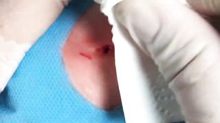 BEST Pimple Popping Big Cystic Acne Blackheads Whiteheads Removal Squeezing Pimples H046_720p - 005