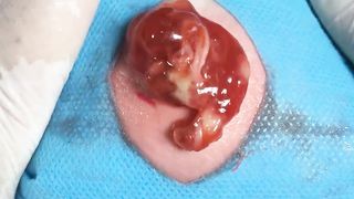 BEST Pimple Popping Big Cystic Acne Blackheads Whiteheads Removal Squeezing Pimples H046_720p - 00 7