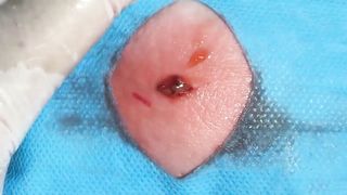 BEST Pimple Popping Big Cystic Acne Blackheads Whiteheads Removal Squeezing Pimples H046_720p - 009