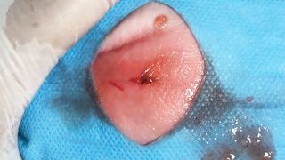 BEST Pimple Popping Big Cystic Acne Blackheads Whiteheads Removal Squeezing Pimples H046_720p - 011