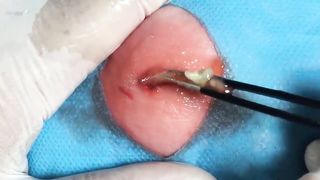 BEST Pimple Popping Big Cystic Acne Blackheads Whiteheads Removal Squeezing Pimples H046_720p - 013