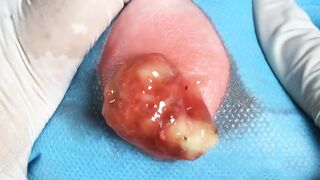BEST Pimple Popping Big Cystic Acne Blackheads Whiteheads Removal Squeezing Pimples H046_720p - 014