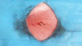 BEST Pimple Popping Big Cystic Acne Blackheads Whiteheads Removal Squeezing Pimples H046_720p - 015