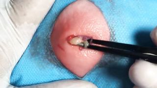 BEST Pimple Popping Big Cystic Acne Blackheads Whiteheads Removal Squeezing Pimples H046_720p - 016