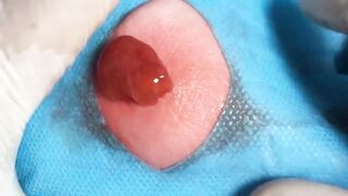 BEST Pimple Popping Big Cystic Acne Blackheads Whiteheads Removal Squeezing Pimples H046_720p - 017