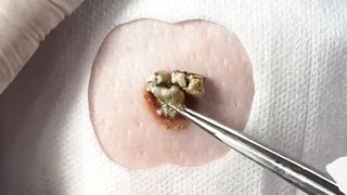 BEST Pimple Popping Big Cystic Acne Blackheads Whiteheads Removal Squeezing Pimples H050_720p - 001