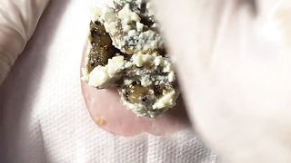 BEST Pimple Popping Big Cystic Acne Blackheads Whiteheads Removal Squeezing Pimples H050_720p - 002