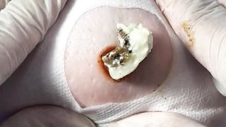BEST Pimple Popping Big Cystic Acne Blackheads Whiteheads Removal Squeezing Pimples H050_720p - 003
