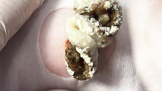 BEST Pimple Popping Big Cystic Acne Blackheads Whiteheads Removal Squeezing Pimples H050_720p - 004