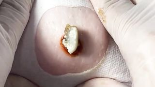 BEST Pimple Popping Big Cystic Acne Blackheads Whiteheads Removal Squeezing Pimples H050_720p - 005