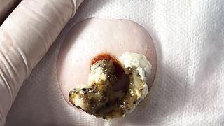 BEST Pimple Popping Big Cystic Acne Blackheads Whiteheads Removal Squeezing Pimples H050_720p - 007