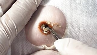 BEST Pimple Popping Big Cystic Acne Blackheads Whiteheads Removal Squeezing Pimples H050_720p - 008