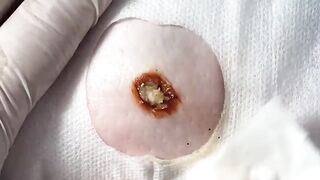 BEST Pimple Popping Big Cystic Acne Blackheads Whiteheads Removal Squeezing Pimples H050_720p - 009