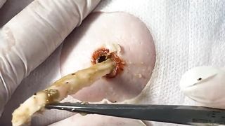 BEST Pimple Popping Big Cystic Acne Blackheads Whiteheads Removal Squeezing Pimples H050_720p - 010