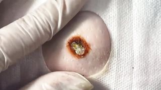 BEST Pimple Popping Big Cystic Acne Blackheads Whiteheads Removal Squeezing Pimples H050_720p - 011