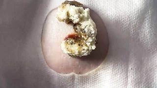 BEST Pimple Popping Big Cystic Acne Blackheads Whiteheads Removal Squeezing Pimples H050_720p - 012