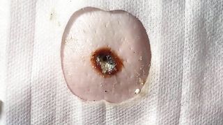 BEST Pimple Popping Big Cystic Acne Blackheads Whiteheads Removal Squeezing Pimples H050_720p - 013
