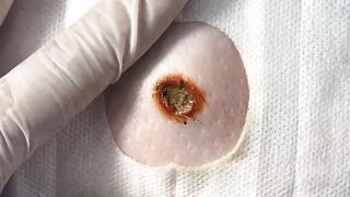BEST Pimple Popping Big Cystic Acne Blackheads Whiteheads Removal Squeezing Pimples H050_720p - 014