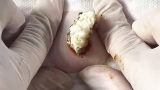 BEST Pimple Popping Big Cystic Acne Blackheads Whiteheads Removal Squeezing Pimples H050_720p - 015