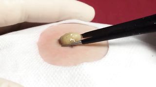 BEST Pimple Popping Big Cystic Acne Blackheads Whiteheads Removal Squeezing Pimples H051_720p - 001