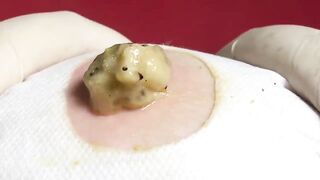 BEST Pimple Popping Big Cystic Acne Blackheads Whiteheads Removal Squeezing Pimples H051_720p - 002