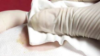 BEST Pimple Popping Big Cystic Acne Blackheads Whiteheads Removal Squeezing Pimples H051_720p - 003