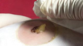 BEST Pimple Popping Big Cystic Acne Blackheads Whiteheads Removal Squeezing Pimples H051_720p - 004