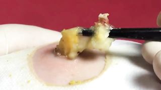 BEST Pimple Popping Big Cystic Acne Blackheads Whiteheads Removal Squeezing Pimples H051_720p - 005