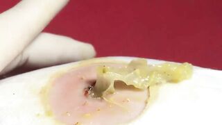BEST Pimple Popping Big Cystic Acne Blackheads Whiteheads Removal Squeezing Pimples H051_720p - 006