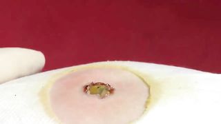 BEST Pimple Popping Big Cystic Acne Blackheads Whiteheads Removal Squeezing Pimples H051_720p - 007