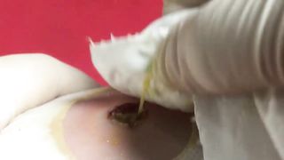 BEST Pimple Popping Big Cystic Acne Blackheads Whiteheads Removal Squeezing Pimples H051_720p - 008
