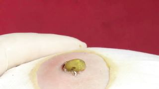 BEST Pimple Popping Big Cystic Acne Blackheads Whiteheads Removal Squeezing Pimples H051_720p - 009