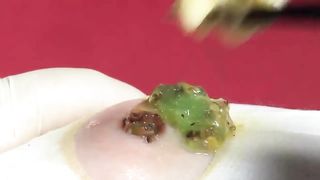 BEST Pimple Popping Big Cystic Acne Blackheads Whiteheads Removal Squeezing Pimples H051_720p - 010