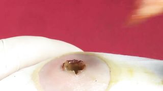 BEST Pimple Popping Big Cystic Acne Blackheads Whiteheads Removal Squeezing Pimples H051_720p - 011