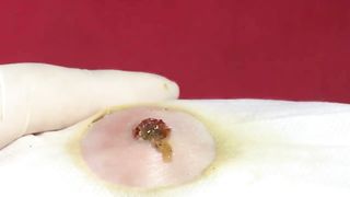 BEST Pimple Popping Big Cystic Acne Blackheads Whiteheads Removal Squeezing Pimples H051_720p - 013