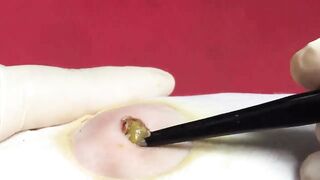 BEST Pimple Popping Big Cystic Acne Blackheads Whiteheads Removal Squeezing Pimples H051_720p - 014