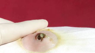 BEST Pimple Popping Big Cystic Acne Blackheads Whiteheads Removal Squeezing Pimples H051_720p - 015