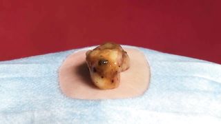 BEST Pimple Popping Big Cystic Acne Blackheads Whiteheads Removal Squeezing Pimples H052_720p - 001