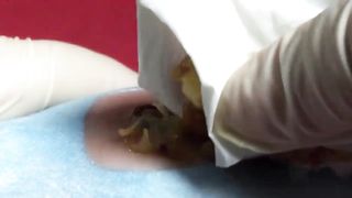 BEST Pimple Popping Big Cystic Acne Blackheads Whiteheads Removal Squeezing Pimples H052_720p - 002