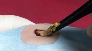 BEST Pimple Popping Big Cystic Acne Blackheads Whiteheads Removal Squeezing Pimples H052_720p - 003