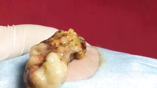 BEST Pimple Popping Big Cystic Acne Blackheads Whiteheads Removal Squeezing Pimples H052_720p - 004