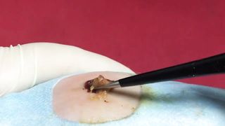 BEST Pimple Popping Big Cystic Acne Blackheads Whiteheads Removal Squeezing Pimples H052_720p - 005