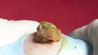 BEST Pimple Popping Big Cystic Acne Blackheads Whiteheads Removal Squeezing Pimples H052_720p - 006