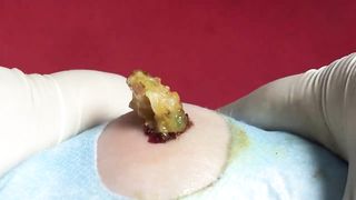 BEST Pimple Popping Big Cystic Acne Blackheads Whiteheads Removal Squeezing Pimples H052_720p - 007
