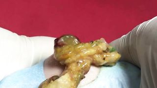 BEST Pimple Popping Big Cystic Acne Blackheads Whiteheads Removal Squeezing Pimples H052_720p - 008