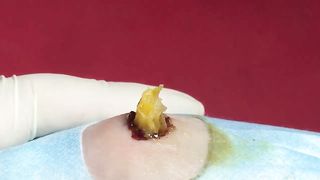 BEST Pimple Popping Big Cystic Acne Blackheads Whiteheads Removal Squeezing Pimples H052_720p - 010